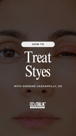 Styes can be annoying, Dr. Vazhappilly discusses the various things you can do to help treat styes. Watch the full interview on our YouTube channel. | OCuSOFT, Inc.