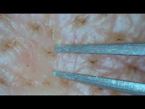 0257 keratin plug removal forehead
