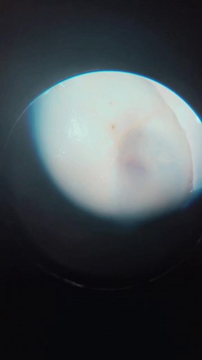 #eyes #research #enucleation #dissection