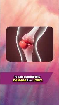 Rheumatoid Arthritis Explained
