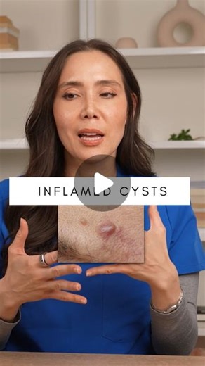 Mamina Turegano, MD, FAAD on Instagram: "Inflamed cysts are something a lot of people struggle with, but what causes them in the first place? Whether it's a sebaceous cyst or an acne cyst, it can get inflamed when bacteria gets irritated or activated in the follicle and causes an immune response. Different factors like diet or local trauma (e.g. picking at a spot) as well as hormonal changes can also make you more prone to inflamed cysts. Like and follow for more skincare tips! #cyst #acne #acne