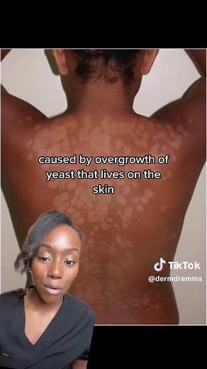 Do you have these dry white or brown patches on your body? It could be pityriasis versicolor #pityriasisversicolor #skincare #nizoral #nizoralshampoo #fungalacne