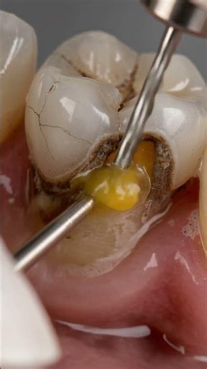 See How Dentists Fix Damaged Teeth #dentistry #satisfying