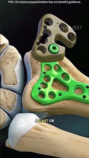 Wrist fracture repair surgery 3D animation distal radius fracture repair #distalradiusfracture