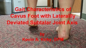1.9K views · 51 reactions | Gait Characteristics of Cavus Feet with...