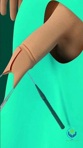 How Laser circumcision is Done Laser circumcision // (3D Animation) // #subscribe