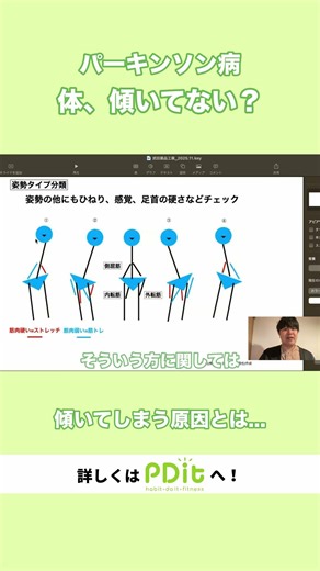 パーキンソン病で体が斜めになる本当の理由
