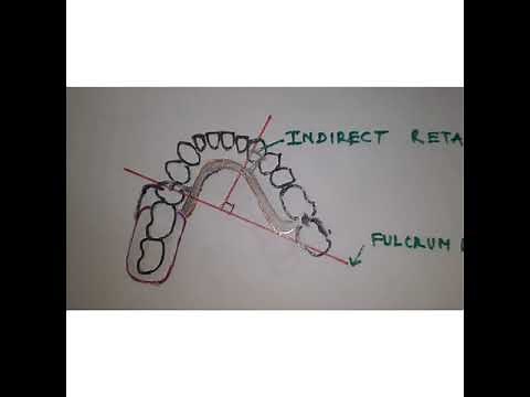 INDIRECT RETAINERS IN RPD