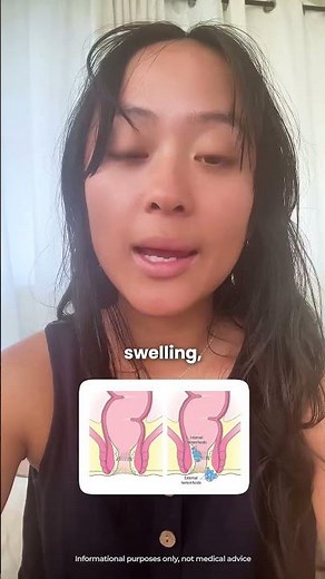 Internal vs. External Hemorrhoids