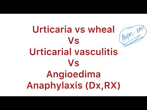 Urticaria vs wheal vs u.vasculitis vs angioedima