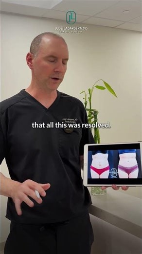 Tummy Tuck and Scar Revision Patient Story