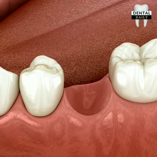 31K views · 620 reactions | Common dental treatment procedure (animation).  visit the page to watch the complete video. | Dental Daily | Facebook