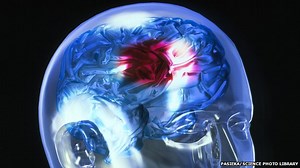 Better stroke patient outcomes? A systematic review