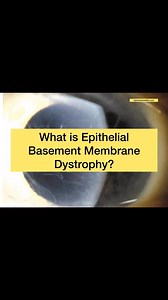 Useful Video on Epithelial Basement Memberane Dystrophy #eye #cornea #eyedisease #ophthalmology #optometrist | Optometry skills