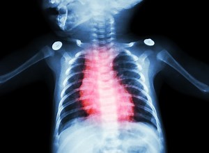 Single-Ventricle Defects Definitively Linked to Brain Abnormalities | Health And Medicine