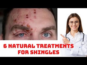 How To Treat Shingles - 6 Natural Treatments for Shingles