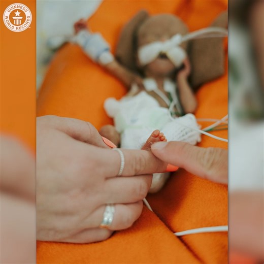 Most premature baby Nash was delivered at a gestational age of exactly 21 weeks, a staggering 133 days earlier than expected. Nash Keen - affectionately known as “Nash Potato” - was born at University of Iowa Health Care, USA | Guinness World Records