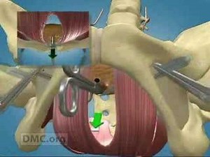 Minimally Invasive Surgery Corrects Urinary Incontinence