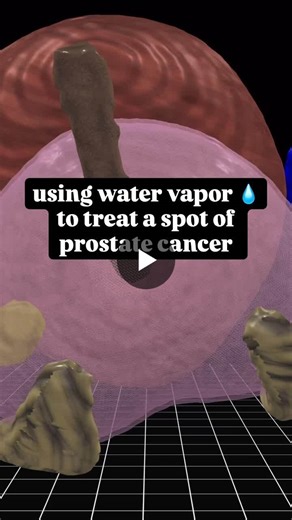 Prostate Cancer Treatment with Vanquish Water Vapor Ablation System Explained | Rahul Mehan posted on the topic | LinkedIn