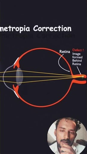 Human eye Hypermetropia and it's correction #upboard #education #physics