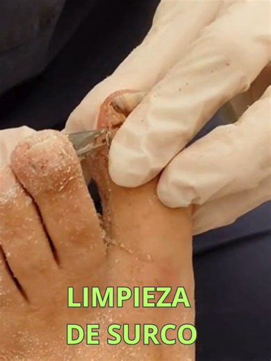 Podología no es solo estética, es salud y precisión en cada movimiento. 🦶✨ Especializarnos es la mejor decisión para brillar en nuestra profesión... #podologia #onicomicosis #cursosonline #hongosenlasuñas #uñaencarnada #emprendedoras #pedicura #cursopodología #mujeremprendedora #halluxvalgus #hiperqueratosis #juanetes #onicomicoses #pies