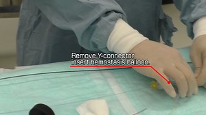 Training video of "5 in 6" procedure - Training Video - Radial Edge Video Library - Terumo Interventional Systems