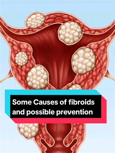 Vitamin D3 and Fibroids: Why Vitamin D3 Matters for Women