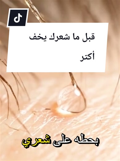 أفضل طرق علاج تساقط الشعر