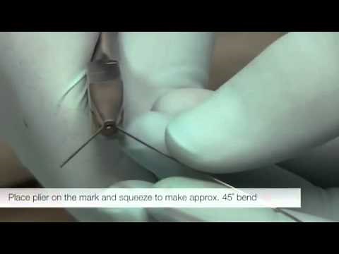 American Orthodontics Omega Loop Bending