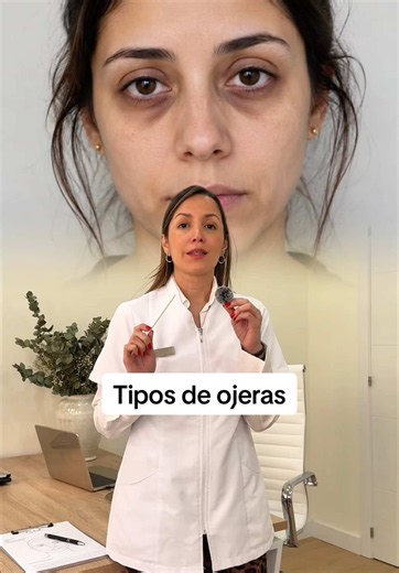 Tipos de ojeras y tratamientos según tu tipo