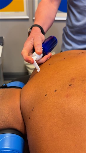 🏆 Shockwave Therapy Shockwave therapy uses focused acoustic waves to jumpstart the body’s healing response. By breaking down scar tissue, increasing circulation, and calming inflammation, it helps with stubborn pain and injuries that don’t respond well to stretching or massage. It’s especially effective for issues like plantar fasciitis, Achilles tendinitis, tennis elbow, calcific tendonitis, and chronic muscle pain. Many athletes and active patients use shockwave to speed up recovery and get b