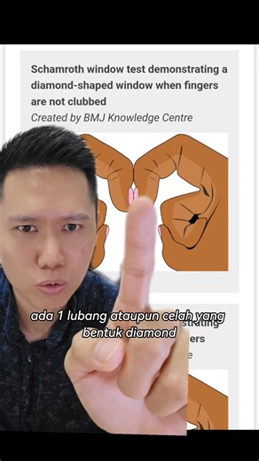 Jari dan kesihatan..Nail clubbing ialah gejala apabila jari berubah bentuk disebabkan oleh kandungan oxygen darah yg rendah untuk tempoh masa yang lama.Banyak punca menyababkan nail clubbing,jika anda ada gajala ini,dinasihatkan pergi cek dengan doctor #lungcancer #hearthealth #jantung #paruparu #mrgenpharmacist | Mr.Gen Pharmacist