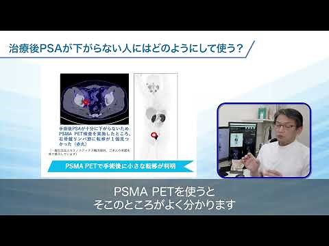 【第3回】『PSMA PETの応用』 - PSMAが変える前立腺がん診療