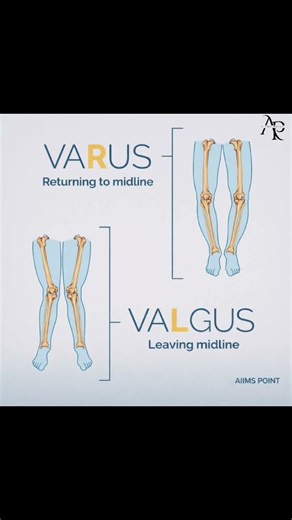 Bow Legs vs Knock Knees | Genu Varus and Genu Valgus Made Simple