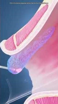 Hemorrhoid Repair (3D Animation) #medicalanimation #doctor #anatomy #science #nurse #animation