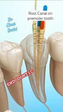 ENDODONTIC , Root Canal on Premolar