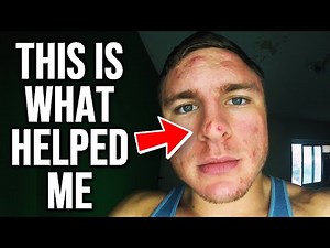 How to Get Rid of Acne on Your Nose