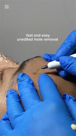 quick and easy mole removal in Singapore available #moleremoval #mole #moleremover #singapore