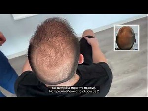 Εντυπωσιακή αλλαγή: FUE Μεταμόσχευση Μαλλιών με 2500 τριχοθυλάκια 🤩 Case #245