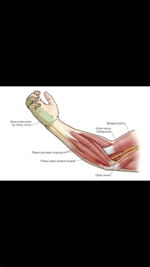 Finger Flexion Sign | Ulnar Nerve Test Explained #meded #ortho #ATC #physio #neurology