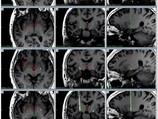 DBS手术-完美植入计划靶点