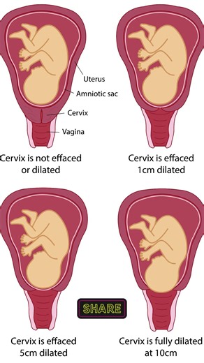 What Does It Mean When Your Cervix Is Dilated? #CervixDilation #PregnancyTips