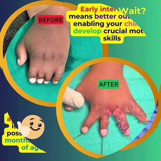 Syndactyly Release (separation of jointed fingers since birth )