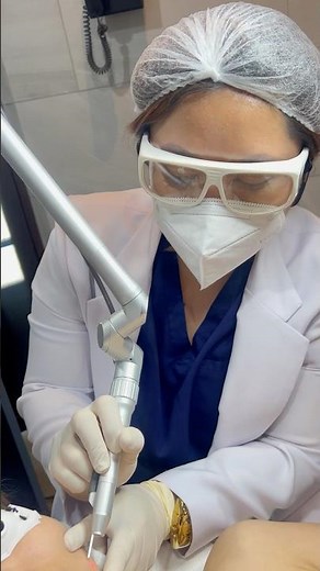 Edge One CO2 Fractional Laser Warts Removal #skincare #skin #laser #edgeone #co2fractionallaser #fyp