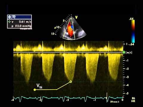25. Measurement of pulmonary vascular resistance