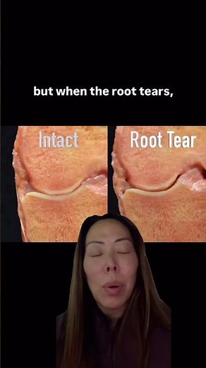 Meniscus Root Tears Explained: The Small Injury That Changes Everything