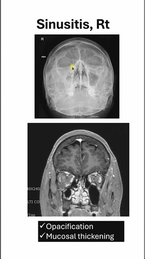 Normal vs Sinusitis — Don’t Miss This Sign
