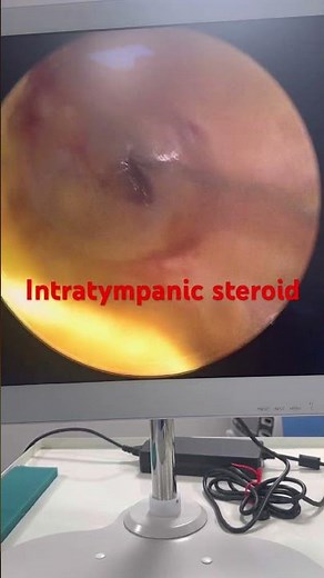 Intratympanic steroid injection
