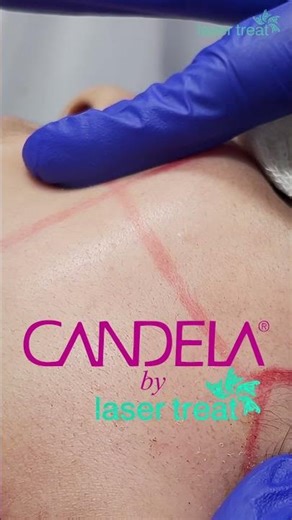 Permanent Hair Removal in 6 Sessions? | Candela Laser #aestheticdermatology #laserhairremoval