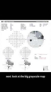 How to Read Your Visual Field Test Like a Pro! 👁️📉 #Shorts